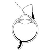 Ocular - Hill Open Access Chirurgical Gonioprism, main gauche
